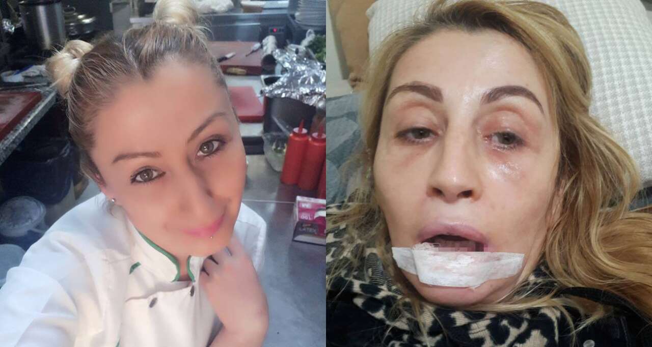Estetik Sonrası Hayatı Kabusa Döndü, Dudağı Çürüdü 1