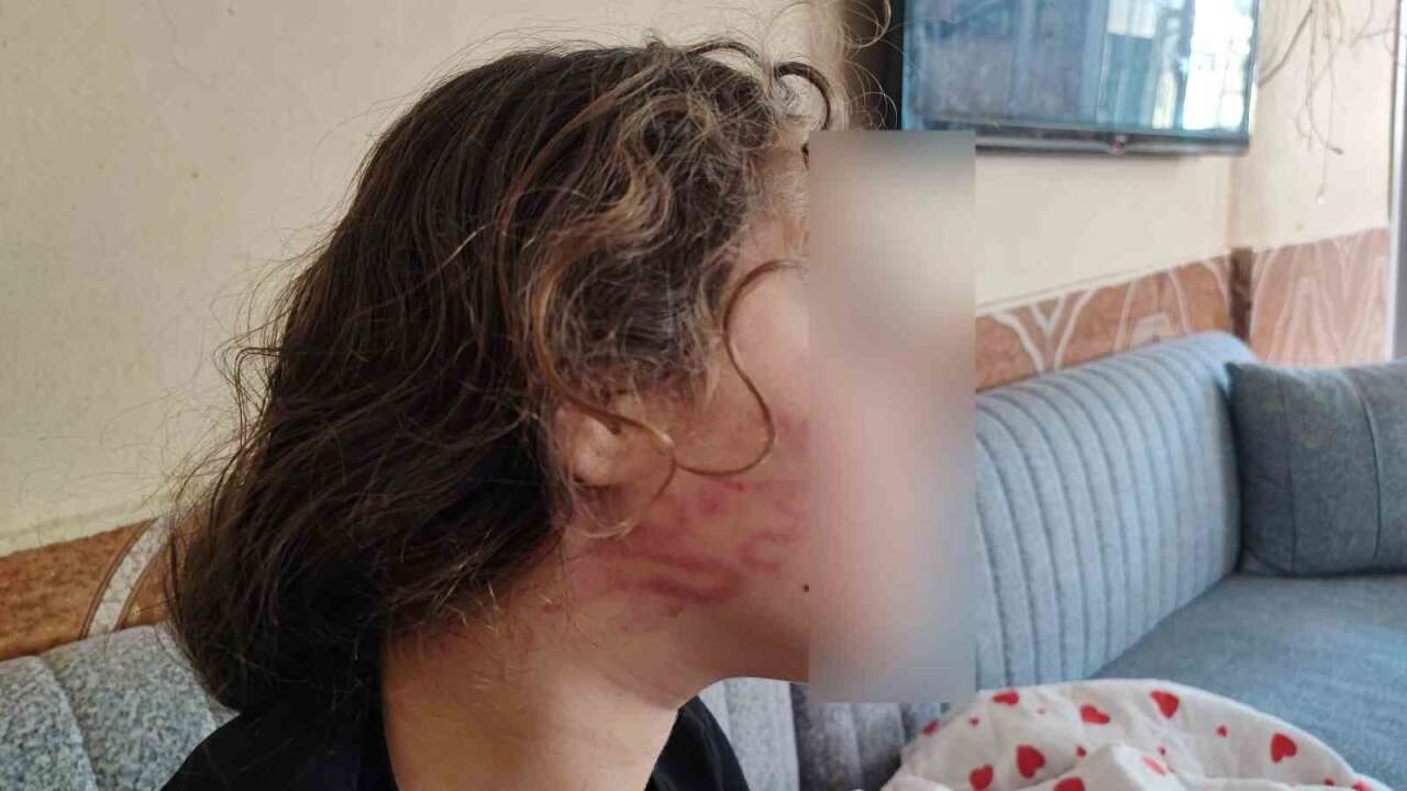 Kardeşiyle Karıştırılan 11 Yaşındaki Epilepsi Hastası Çocuk Darp Edildi İddiası
