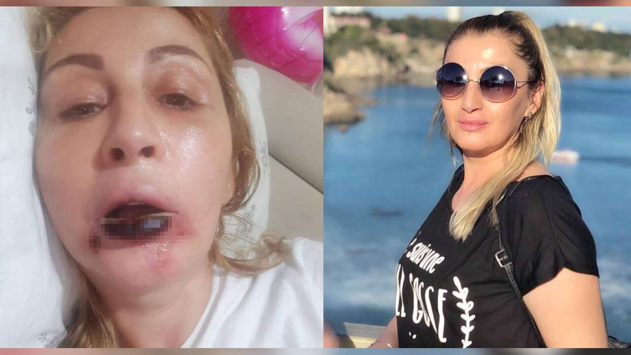 Estetik Sonrası Hayatı Kabusa Döndü, Dudağı Çürüdü