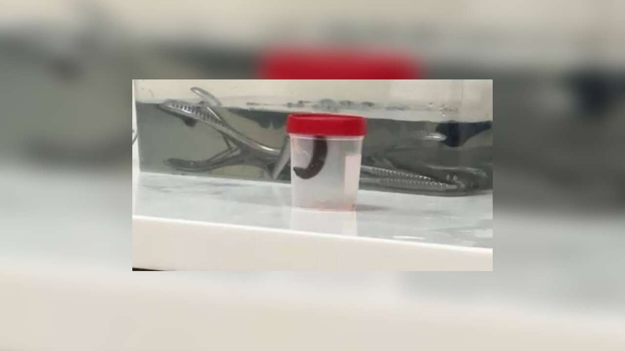6 Yaşındaki Çocuğun Boğazından Çıkan Şok Etti