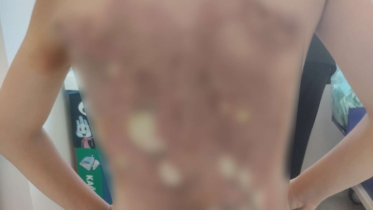 12 Yaşındaki Çocuğu Kolonya Dökerek Yaktılar İddiası