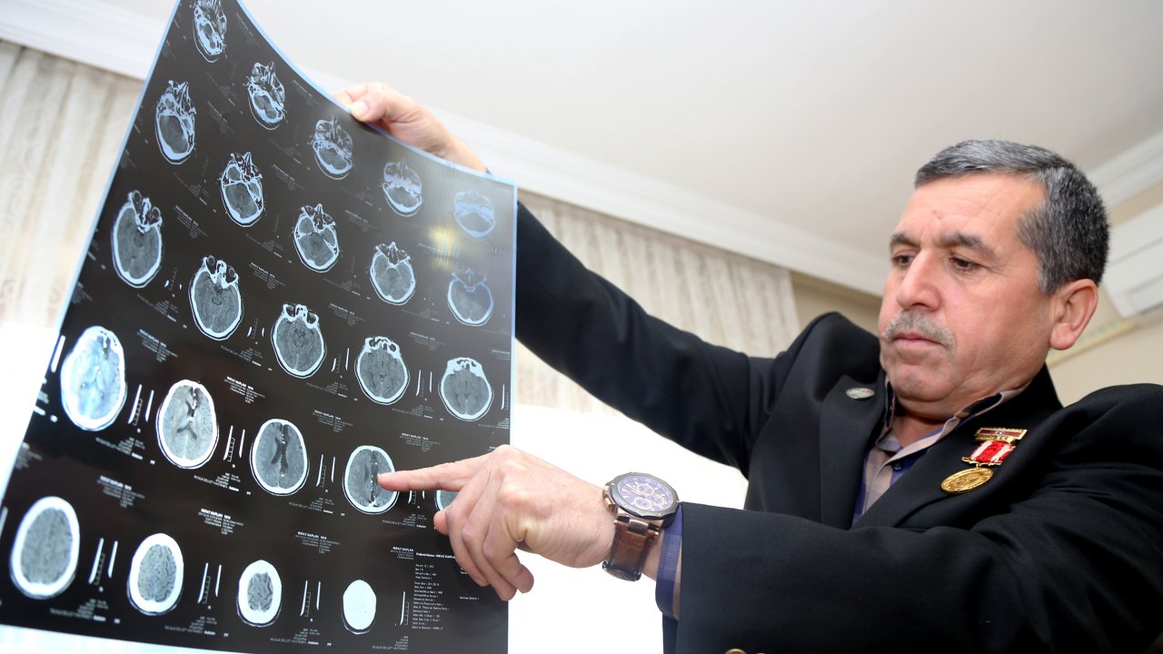 Kahraman gazi 28 yıldır başındaki 14 şarapnel parçasıyla yaşıyor