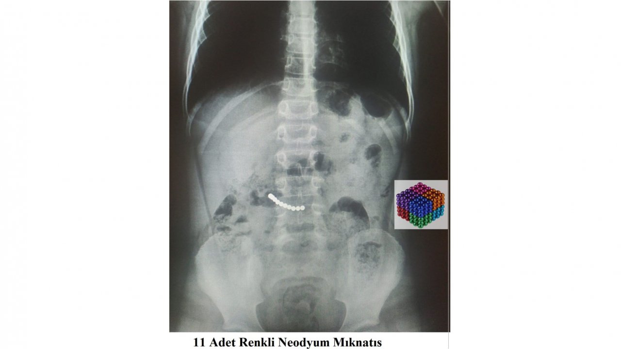 Midesinden 11 mıknatıs çıktı