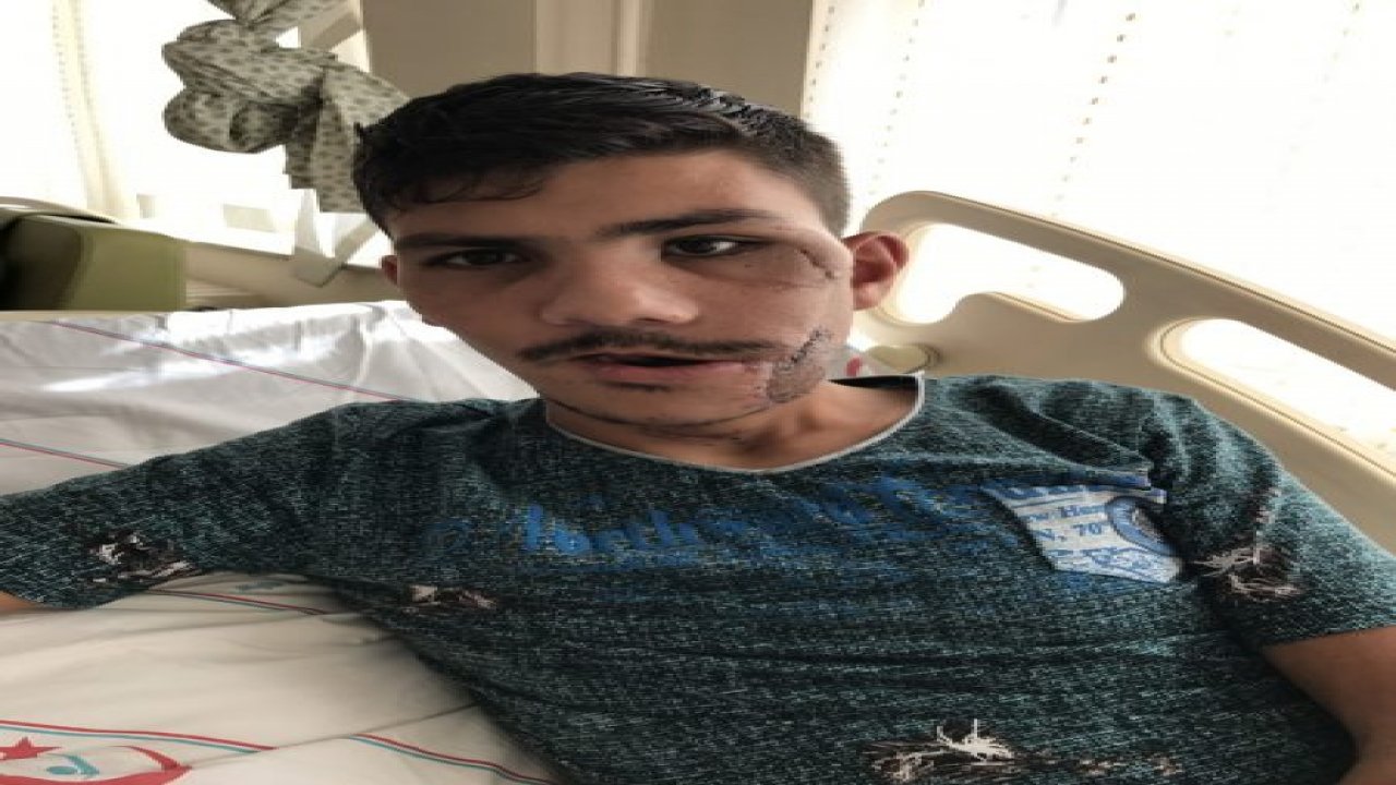 Kaval kemiğinden çene yapıldı