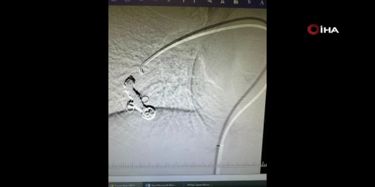 Yıllardır astım bronşit denilen çocuğun akciğerinde yumak çıktı