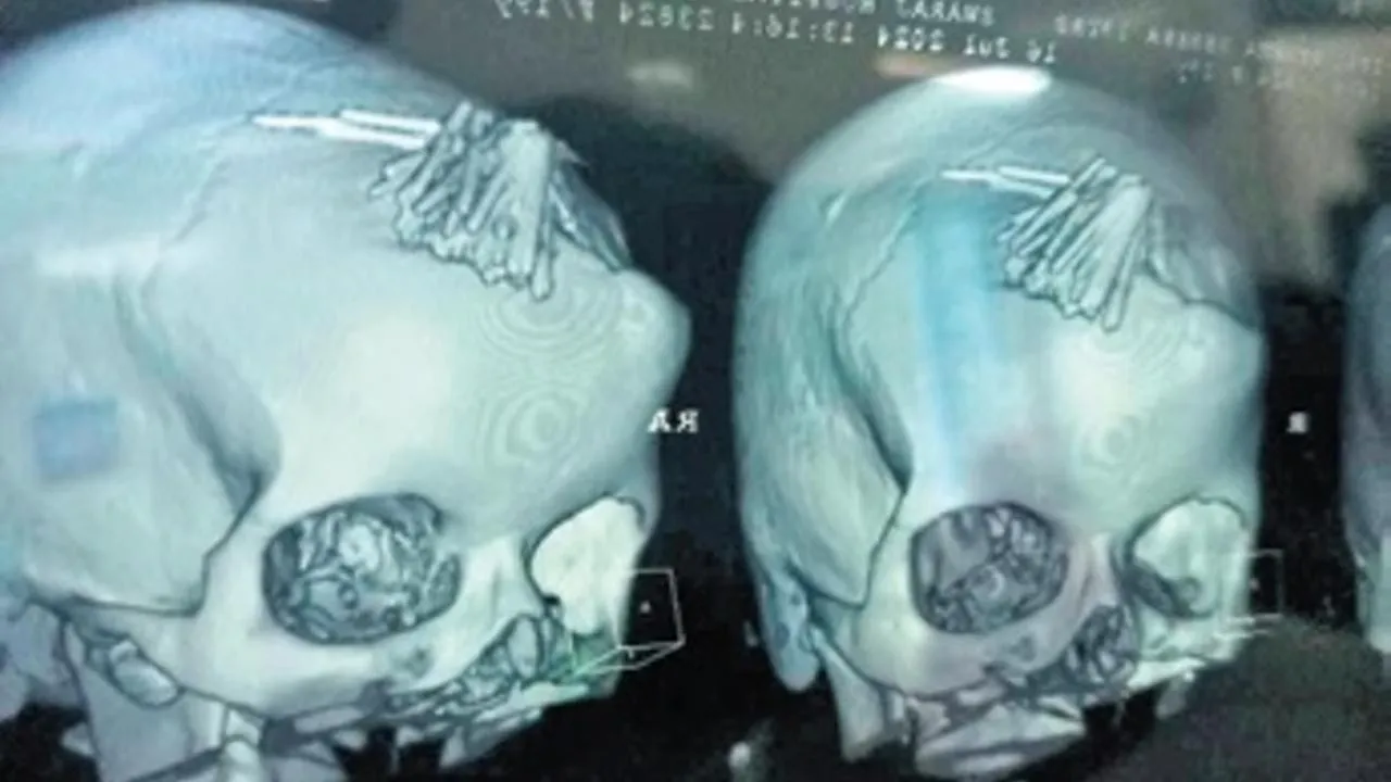 Baş ağrısı şikayetiyle hastaneye gitti, kafatasından 77 iğne çıkarıldı!