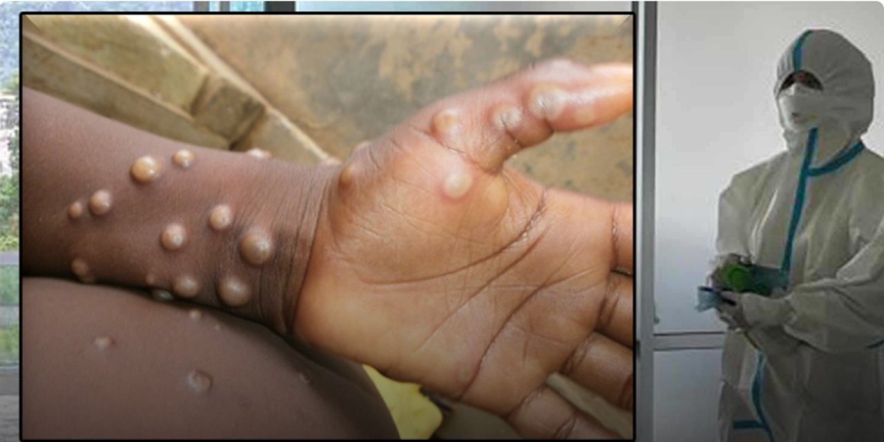 Turizm noktalarında ‘Maymun çiçeği’ uyarısı!