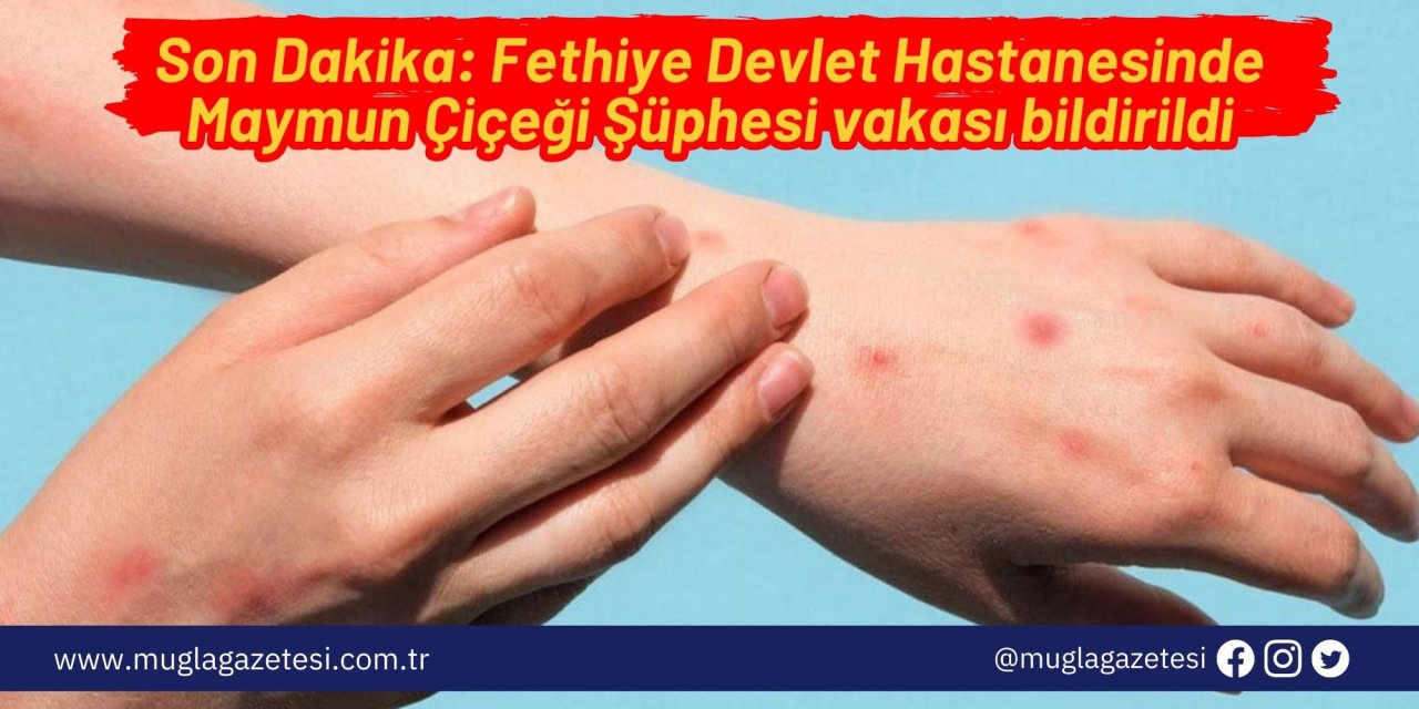 Son Dakika: Fethiye Devlet Hastanesinde Maymun Çiçeği Şüphesi vakası bildirildi