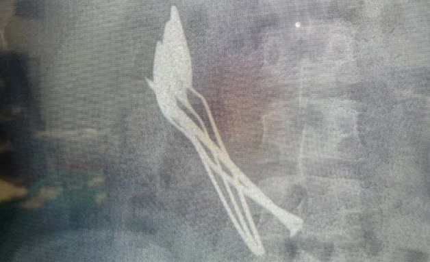 Çocuğun midesinden çıkanlar şoke etti!