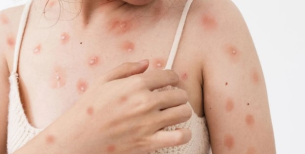 Ülkede maymun çiçeği vakası artıyor