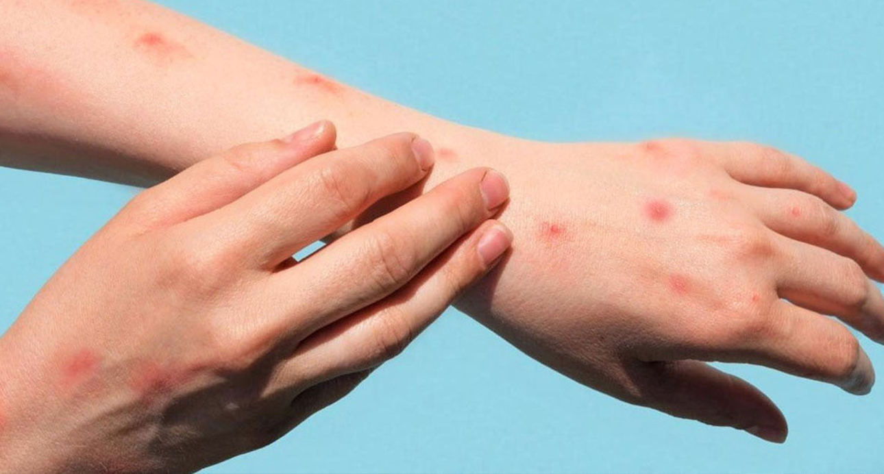 M-çiçeği virüsünün yeni varyantı tespit edildi