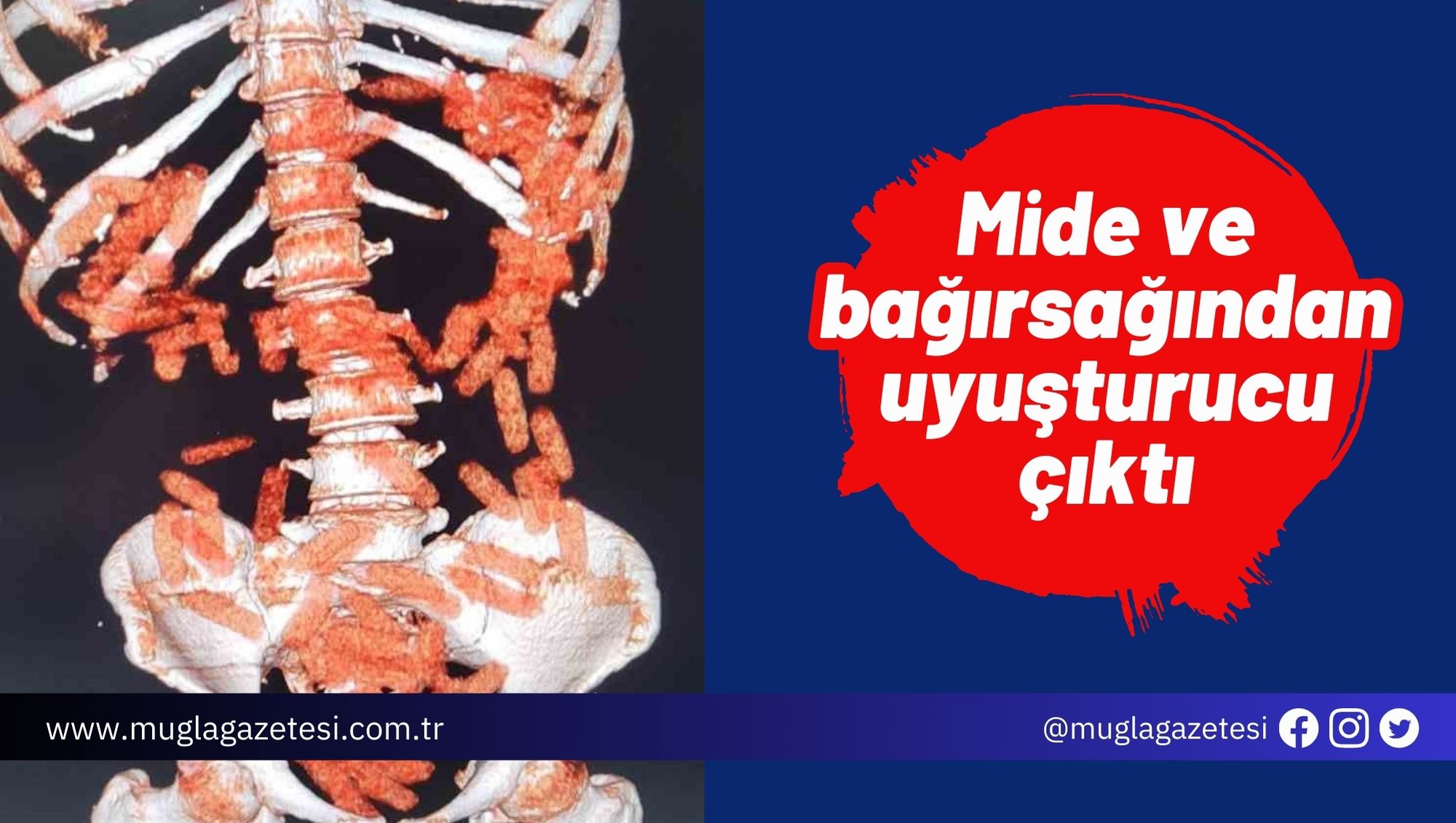 Mide ve bağırsağından uyuşturucu çıktı