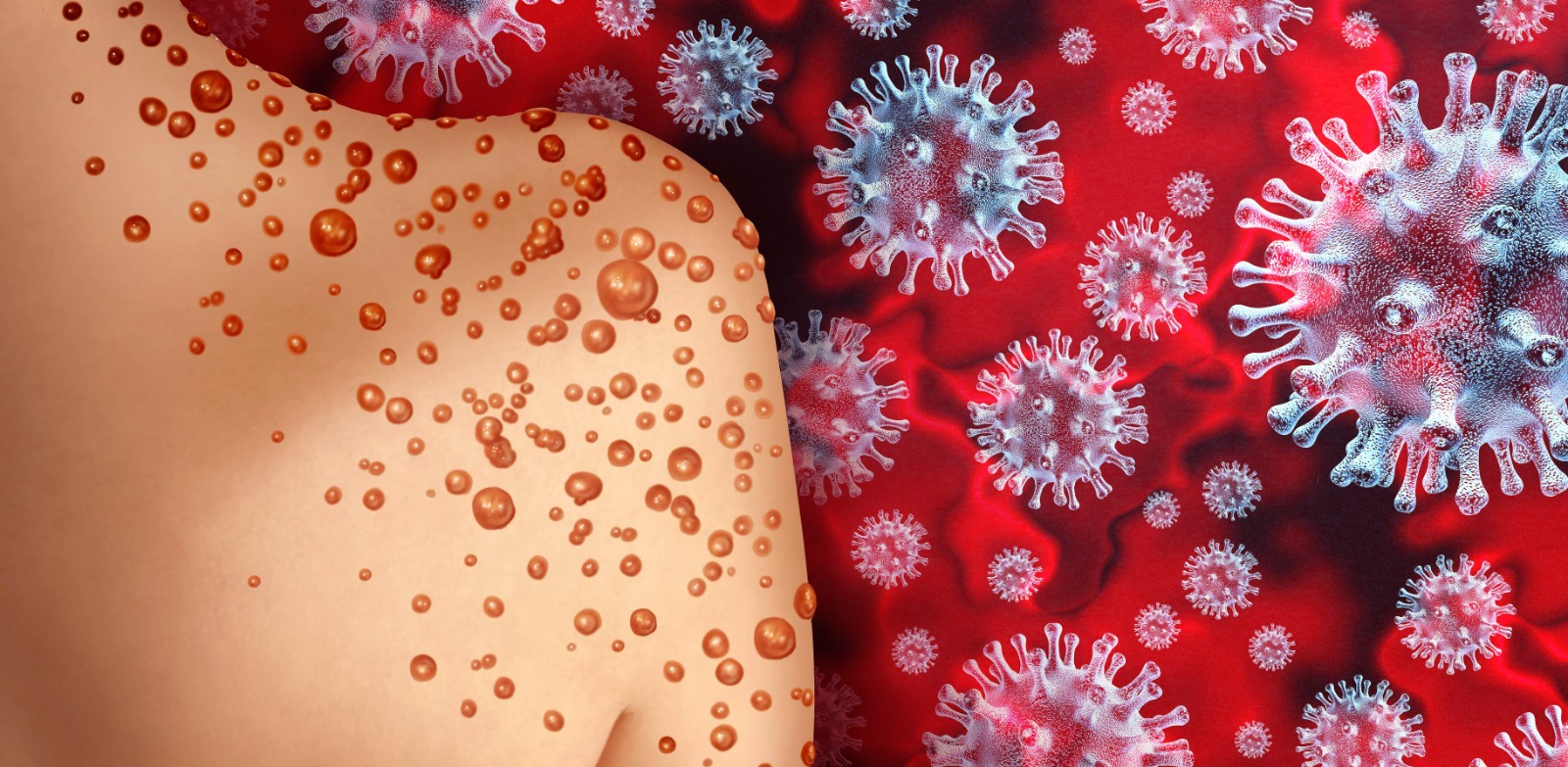 Maymun çiçeği virüsü nedir? Riskli midir?