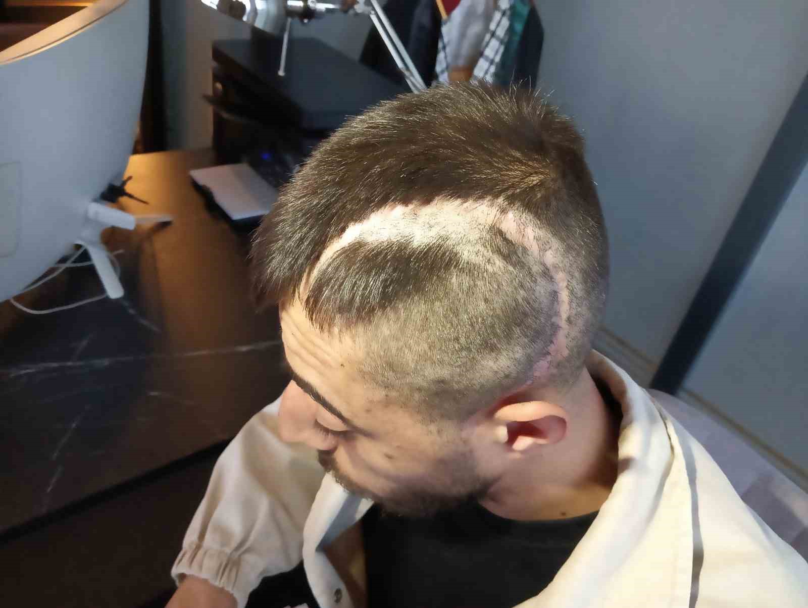 KAN DONDURAN OLAYDA YÜZDE 32 FİZİKSEL ENGELLİ KALDI