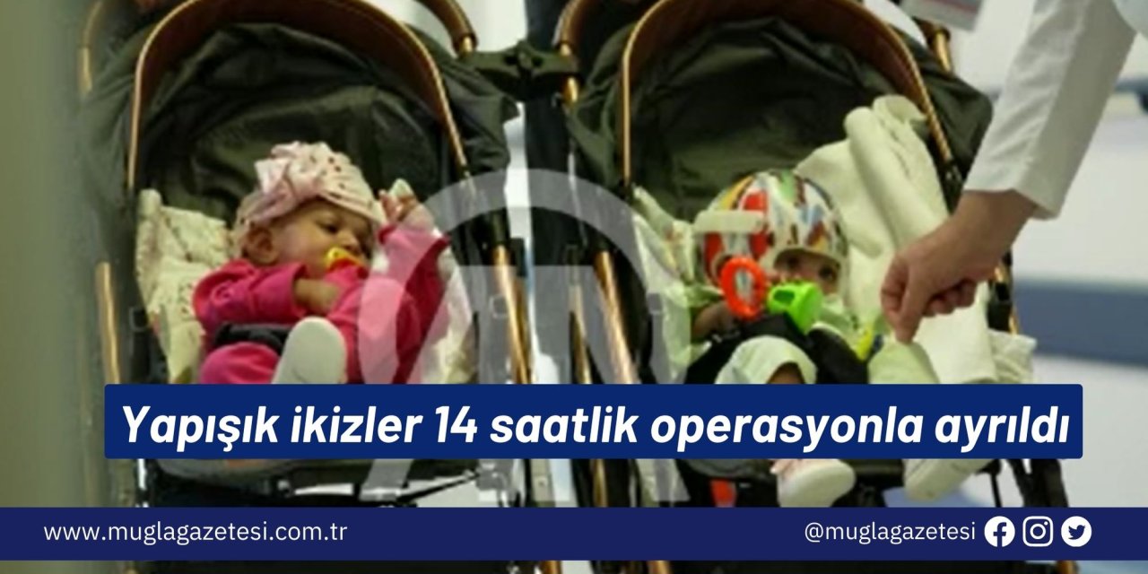 Yapışık ikizler 14 saatlik operasyonla ayrıldı