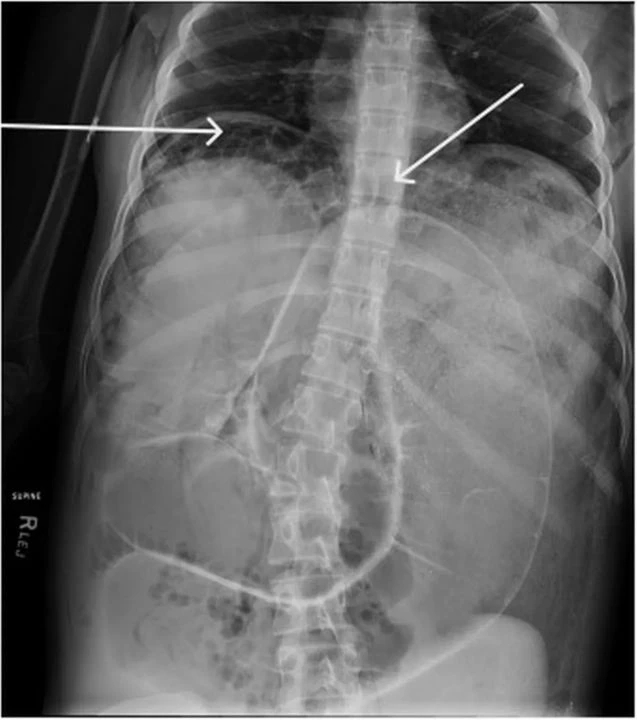 Midesinden Çıkan Doktorları Bile Şoke Etti
