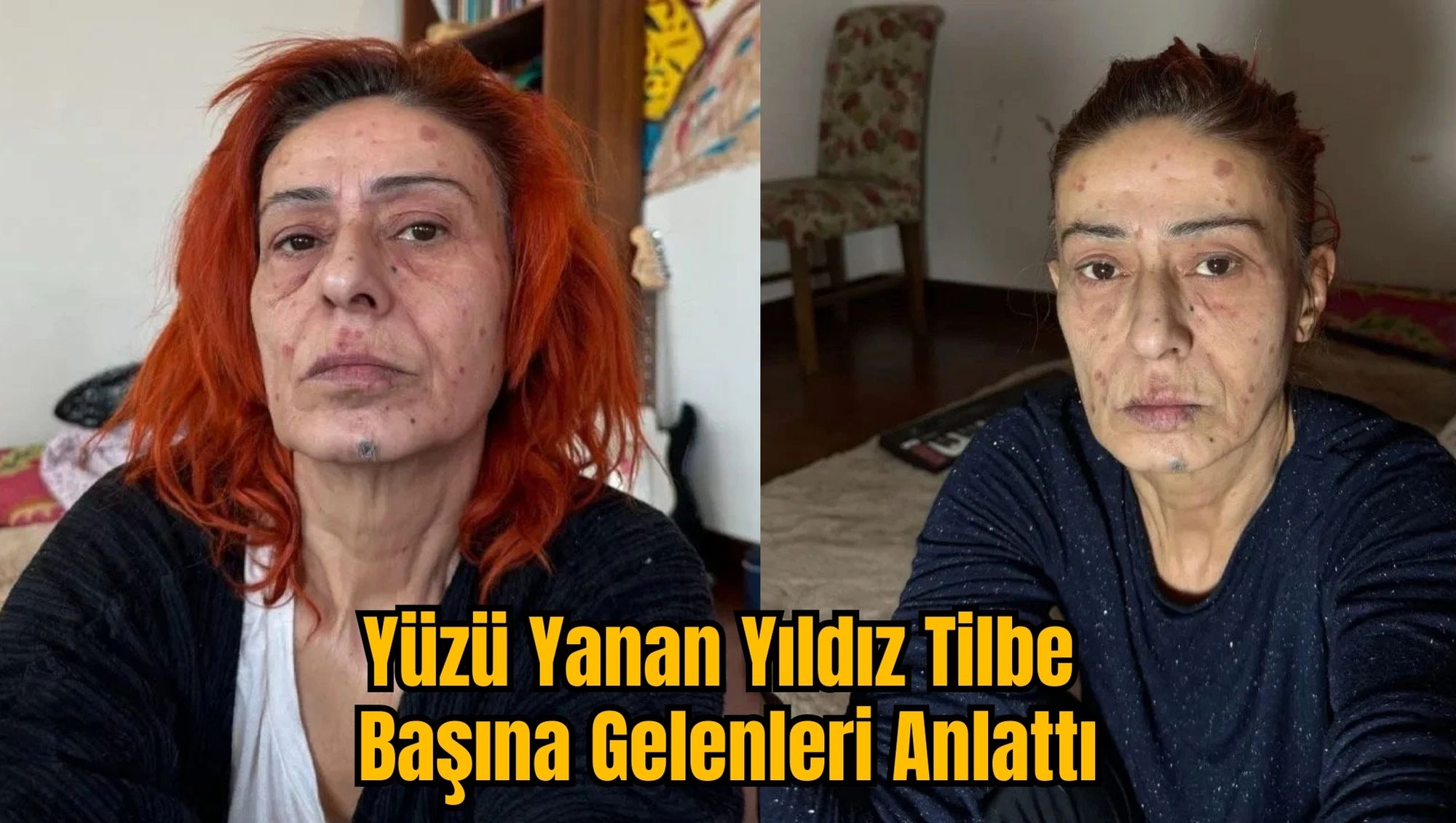 Yüzü Yanan Yıldız Tilbe Başına Gelenleri Anlattı