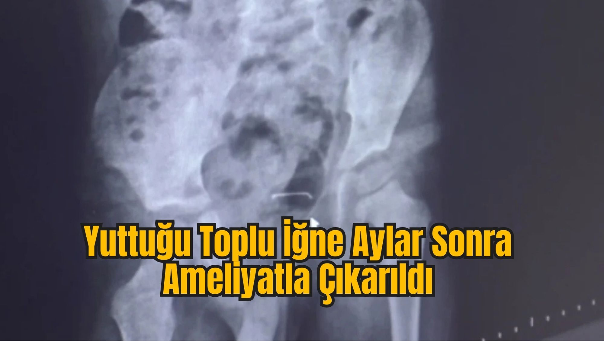Yuttuğu Toplu İğne Aylar Sonra Ameliyatla Çıkarıldı