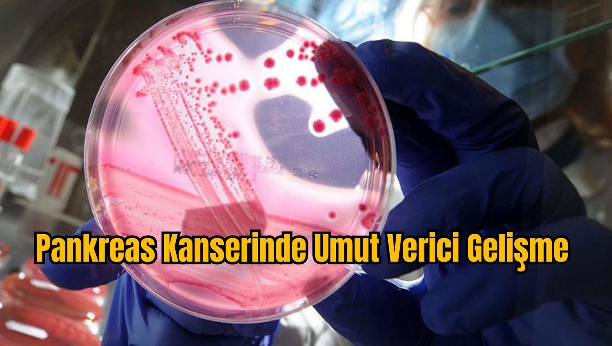 Pankreas Kanserinde Umut Verici Gelişme