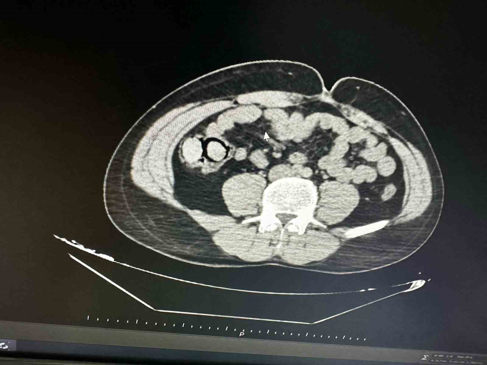 Polisten Kaçmadı :Midelerinden 10 Parça Halinde Yasaklı Madde Çıktı