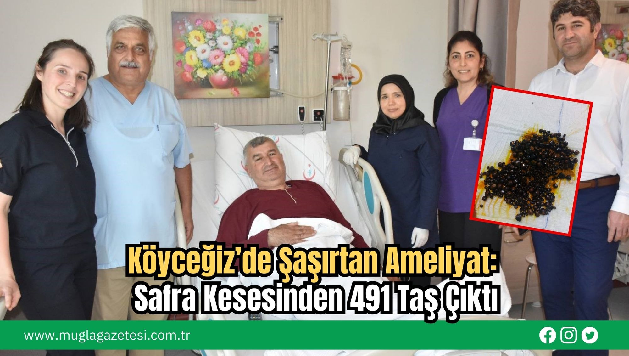 Köyceğiz’de Şaşırtan Ameliyat: Safra Kesesinden 491 Taş Çıktı