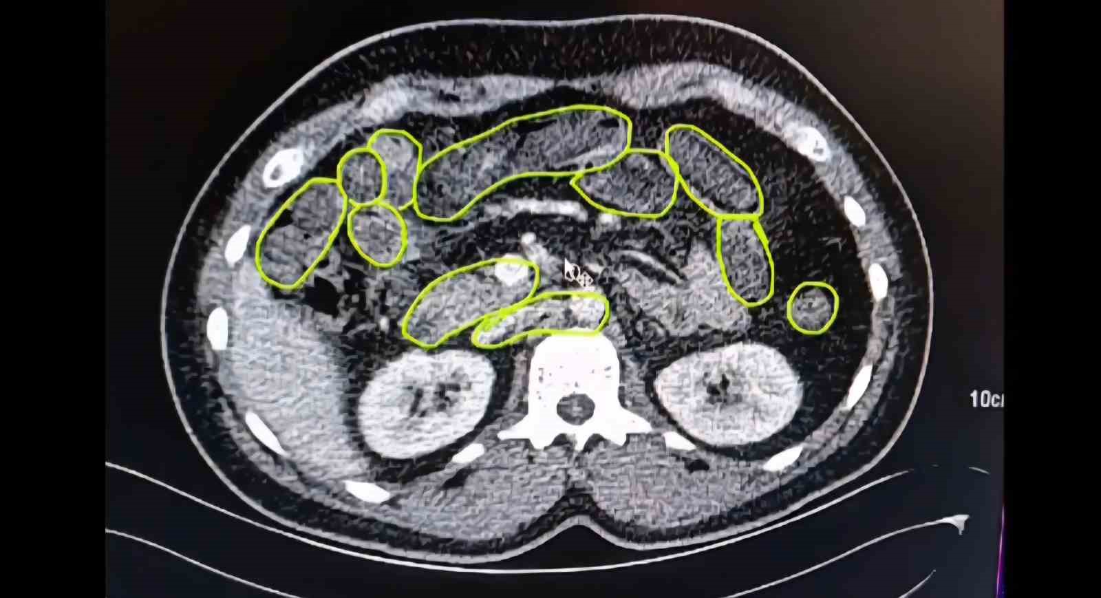3 Şüphelinin Mide ve Bağırsaklarında Yasaklı Madde Çıktı