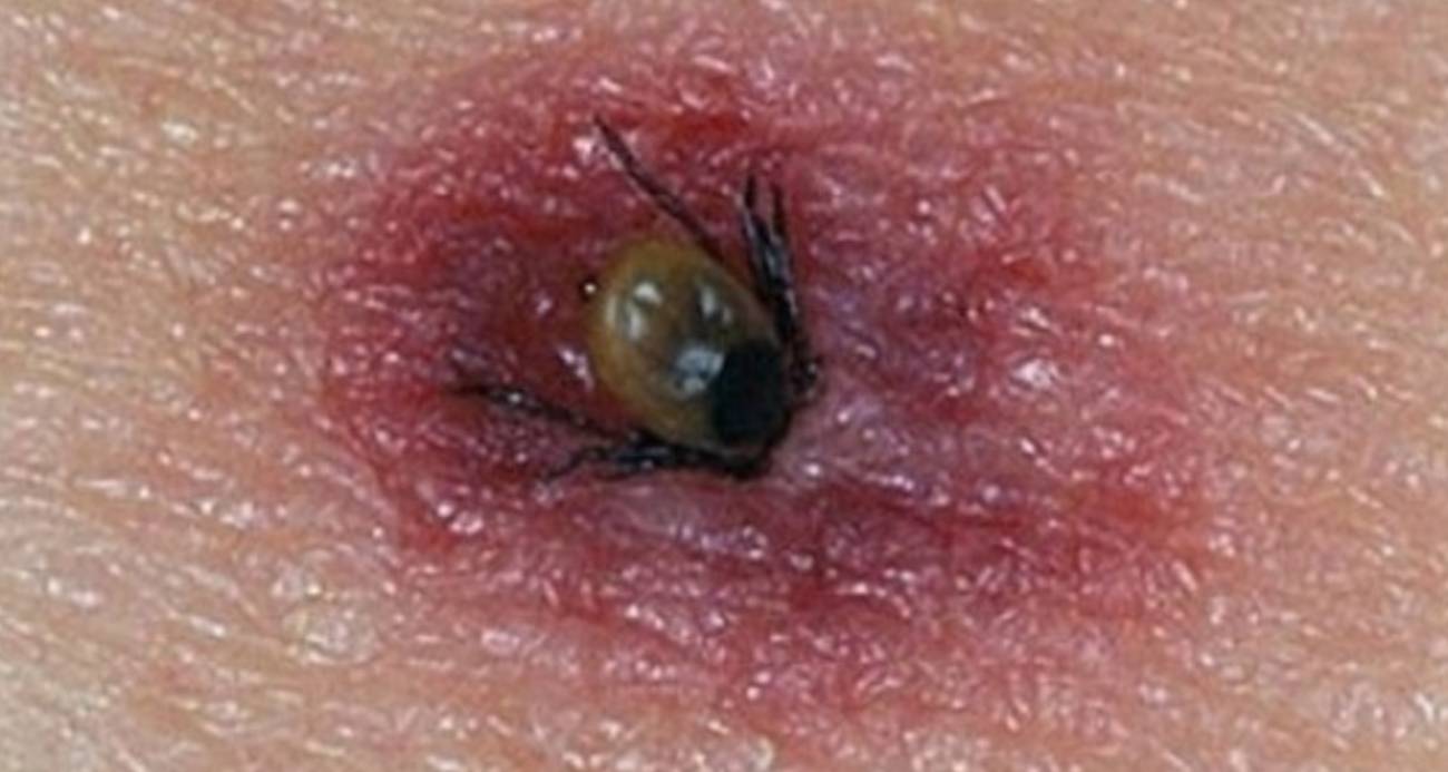 KKKA Vakası: Vücuduna Yapışan Keneyi Çıkartan Çocuğun Testi Pozitif Çıktı