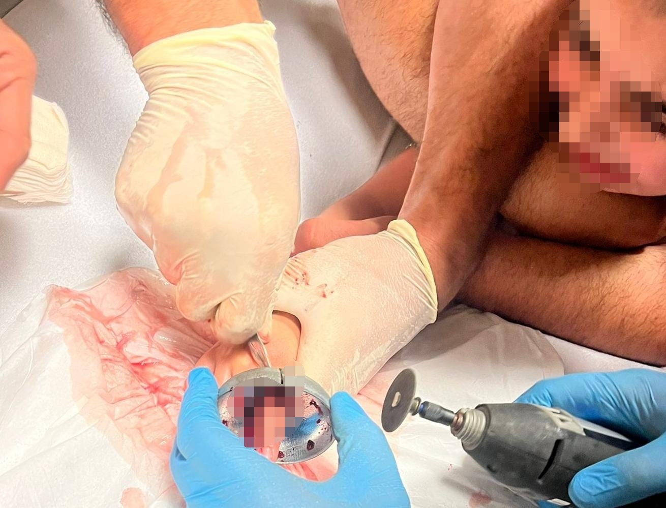 5 Yaşındaki Çocuğun Parmağı Çeşme Aynasına Sıkıştı