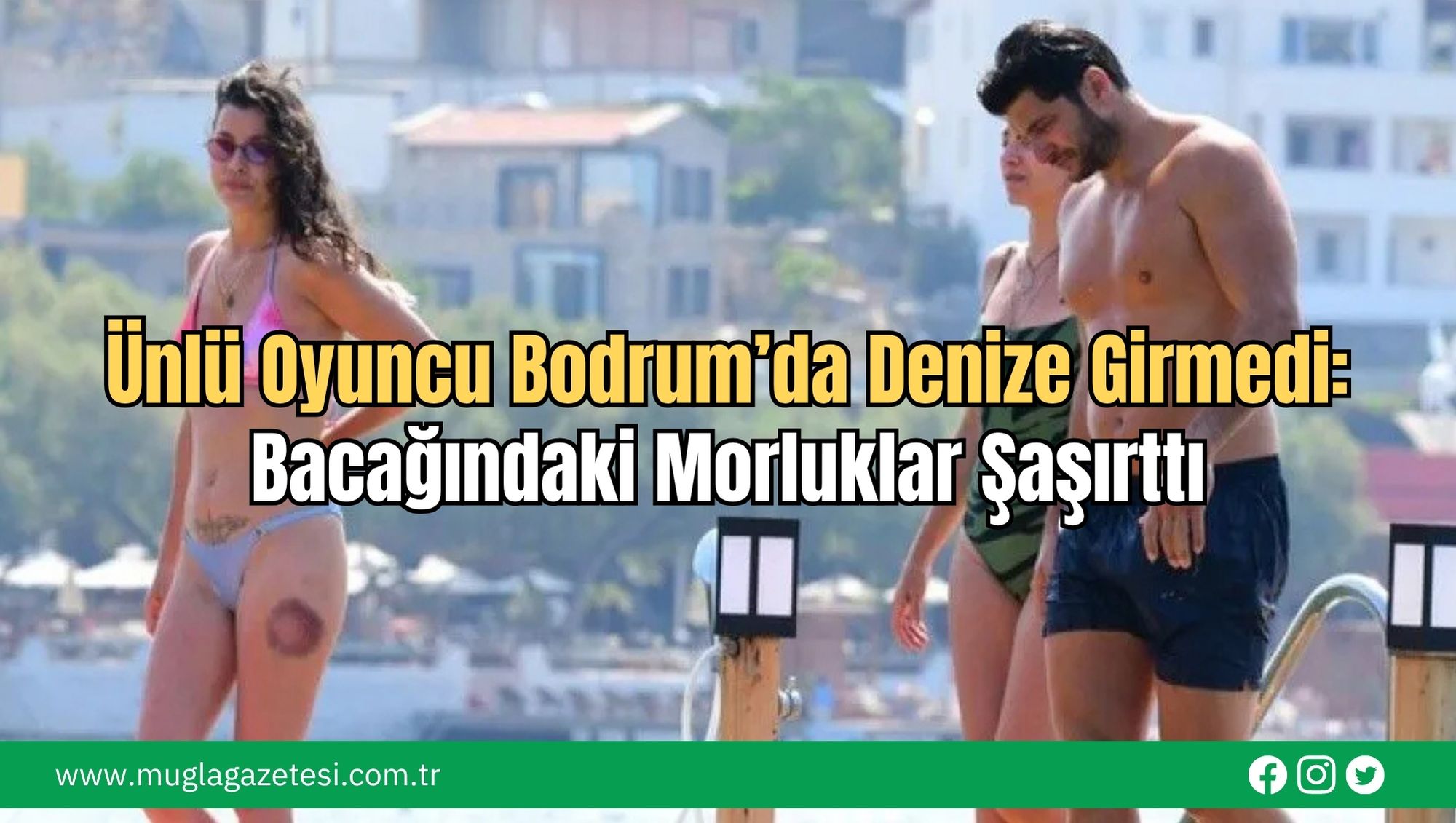 Ünlü Oyuncu Bodrum’da Denize Girmedi: Bacağındaki Morluklar Şaşırttı