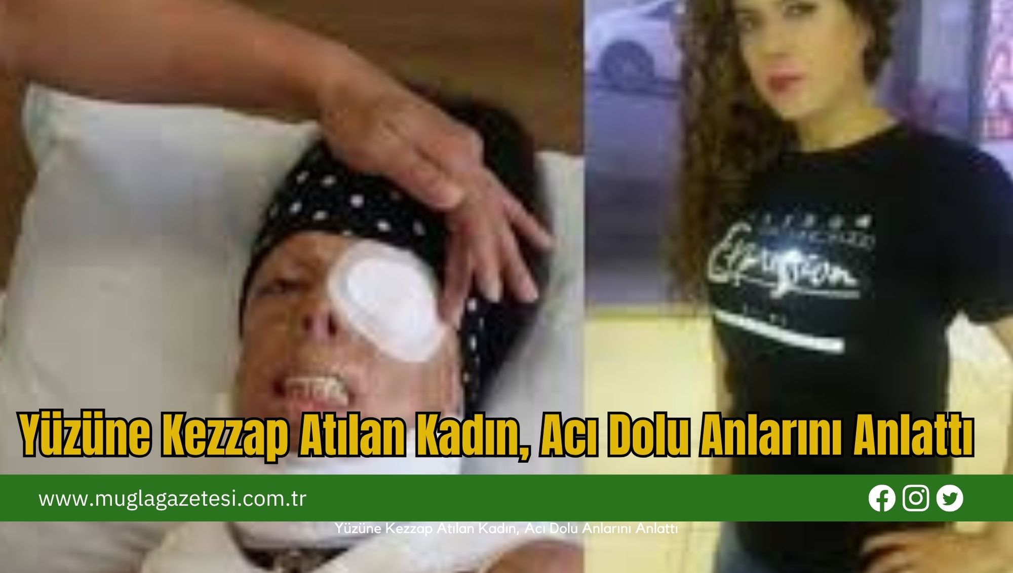 Yüzüne Kezzap Atılan Kadın, Acı Dolu Anlarını Anlattı