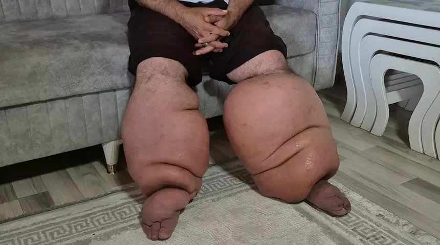 15 Yıldır Fil Hastalığıyla Mücadele Eden Adam Yürüyemez Hale Geldi