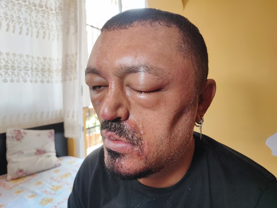 Siyah Saç Hayali, Arı Sokması Gibi Şişkinlikle Bitti