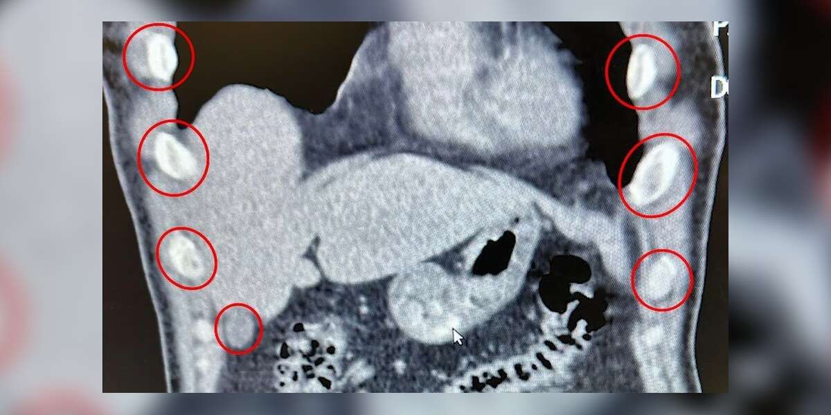 Şok Operasyon: Midelerinden 136 Kapsül Uyuşturucu Çıktı