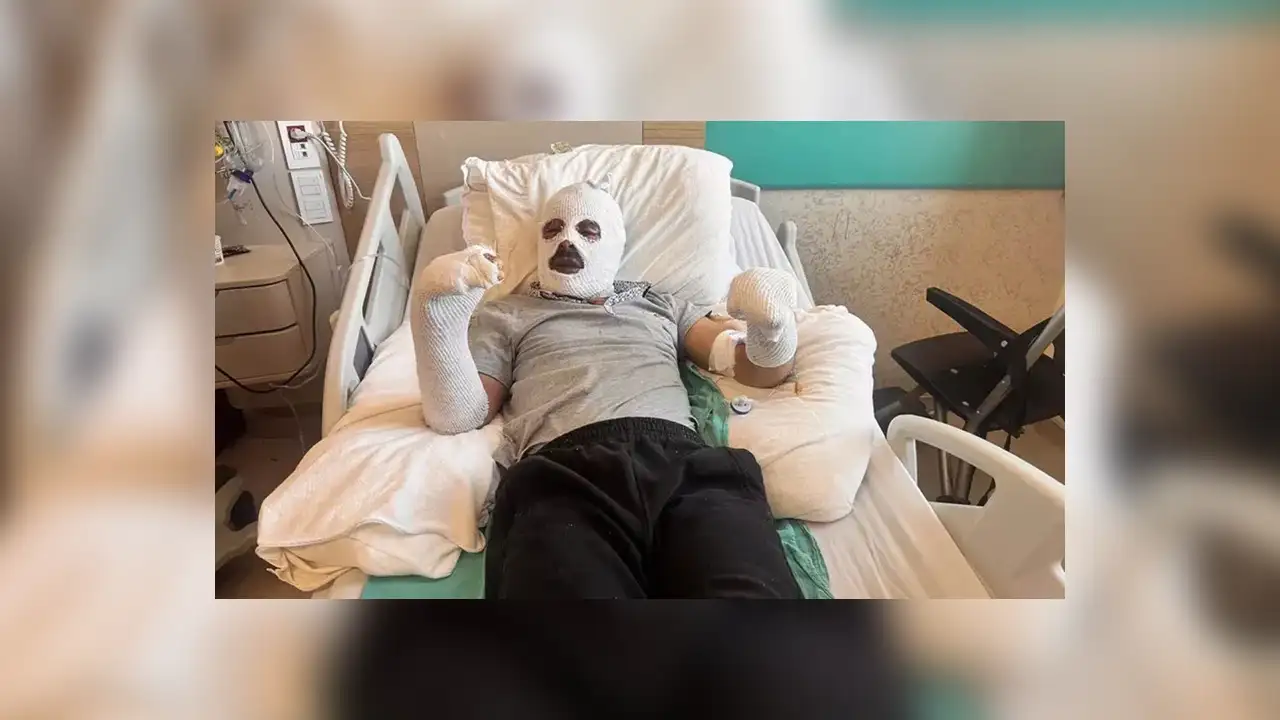 Çay Demlemek İsterken Tüp Patladı: Vücudunun Yüzde 26’sı Yandı